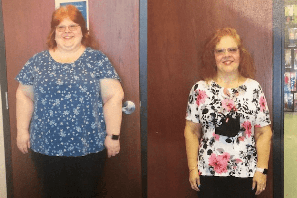 Before and after pictures of woman who had bariatric surgery.