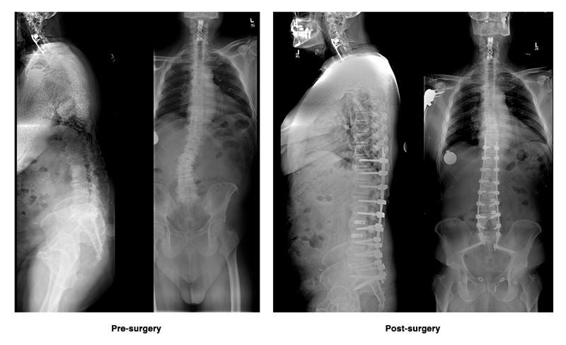Eric A.'s pre-surgery and post-surgery x-rays.
