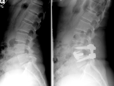 spine xray pre and post surgery.
