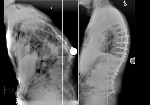 spine surgery before and after x-rays