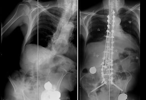 spine surgery before and after x-rays