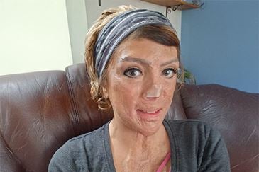 Alisia burn patient at Ascension Columbia St. Mary’s Regional Burn Center in Milwaukee