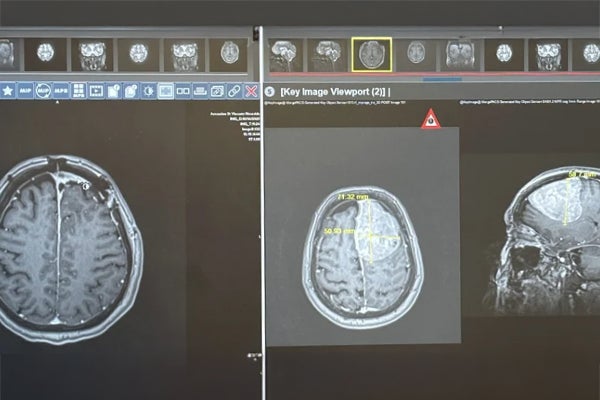 MRI brain scans showing axial and sagittal views of a large left frontal lobe mass measuring approximately 71 x 50 mm, later identified as a meningioma tumor that caused Karen’s seizures and required surgical removal at Ascension St. Vincent’s Riverside.