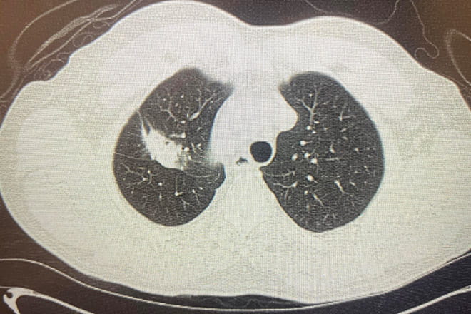 Pulmonologists at Ascension St. Vincent's are utilizing the Ion robotic-assisted bronchoscopy to improve the accuracy and precision of the biopsy of a potentially cancerous nodule in the lungs. The large white area in this lung CT shows the tumor that doctors were able to remove from Swain.