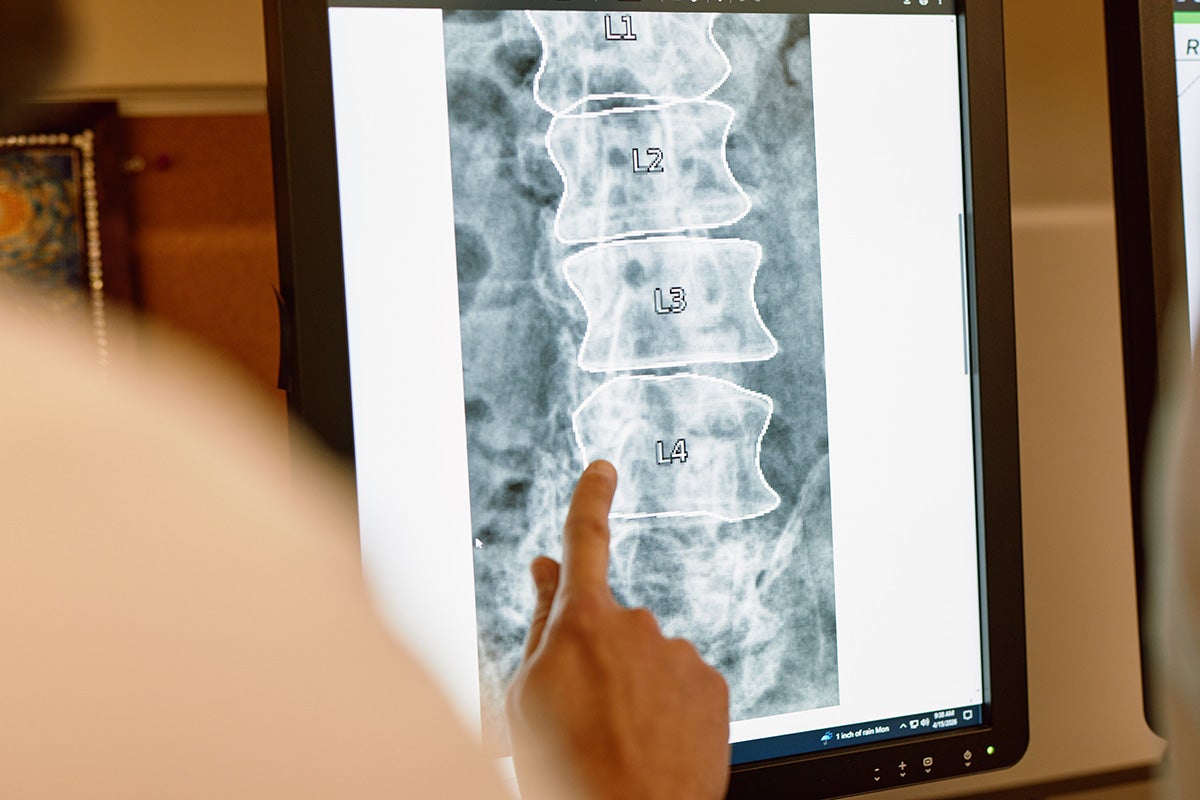 Diagnostic spine scan used to evaluate scoliosis and other spinal deformities at Ascension Texas Spine & Scoliosis