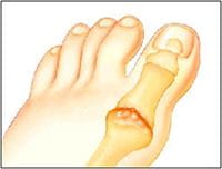Big toe arthritis