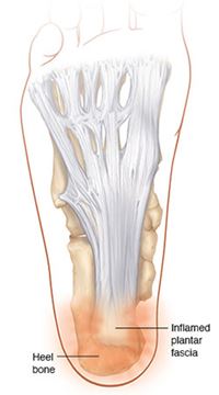 Plantar fasciitis