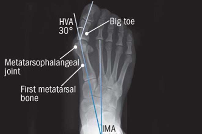 Ascension Southeast Wisconsin podiatrists perform ankle replacement and reconstructive foot surgery.