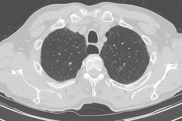 A lung screening image